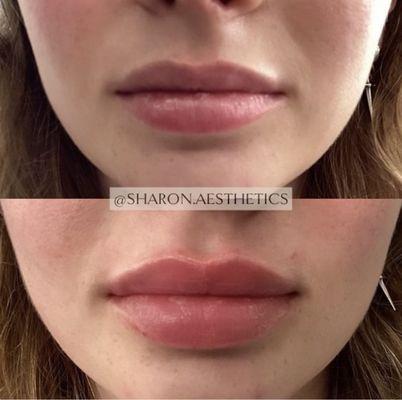 Beautiful lip enhancement