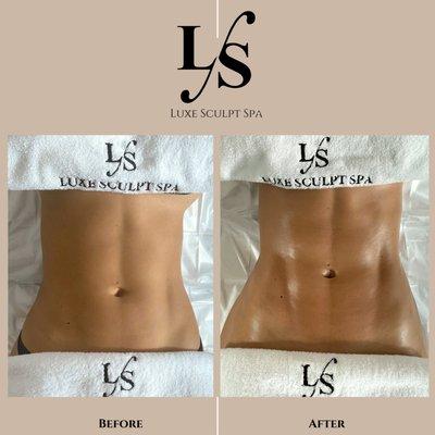 Before and After a Non - Invasive Body Sculpting massage at Luxe Sculpt Spa