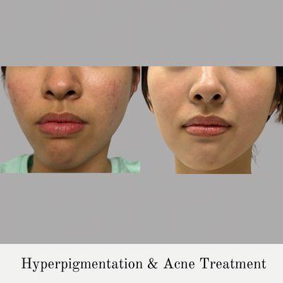 Hyperpigmentation & Acne Treatment