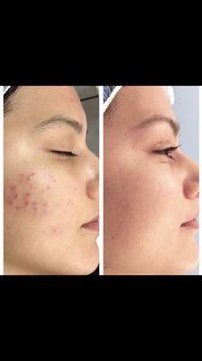 Chemical peels are great for anyone who suffers from large pores of acne.