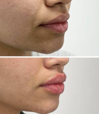 Lip filler! (Before top photo and after bottom photo)