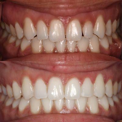 Done by: Dr.Coakley‍
Results after 5 months of Invisalign with NO refinements!
Invisalign and cosmetic fillings have been completed.