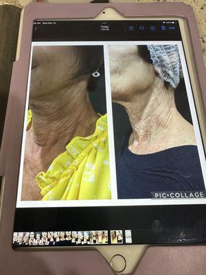 Before and after pics of my Neck after radiesse.