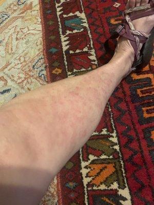 I got this rash after a pedicure!