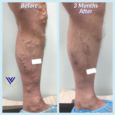 Before And After Varicose Vein Treatment