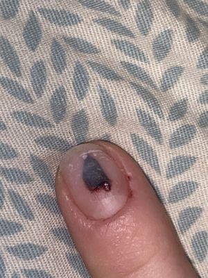 A hole in my finger.