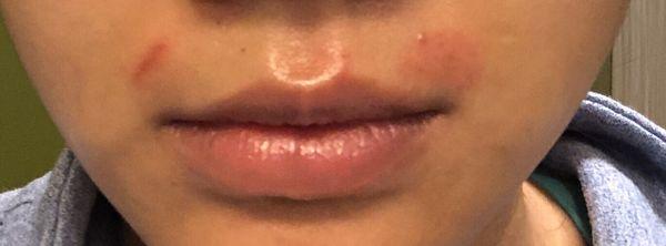 3 Burns/cuts on lip wax. Terrible!!