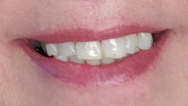 My beautiful new teeth And they're my own