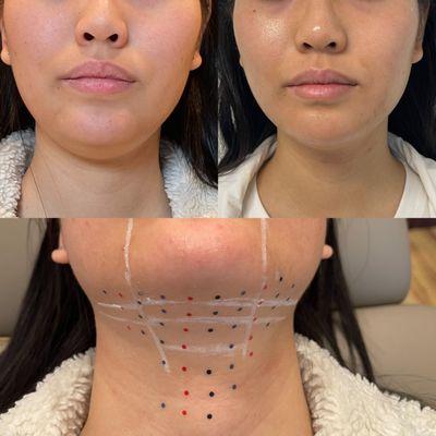 Kybella injection after two treatments for double chin.