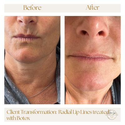 Client Transformation Radial Lips Lines treated with Botox done by Mara Gomez (APRN/MRN)