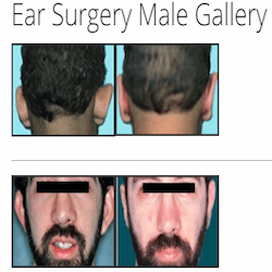 Ear Surgery Male