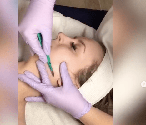 Dermaplaning- effectively removes dead skin and villus hairs leaving the skin soft and clear