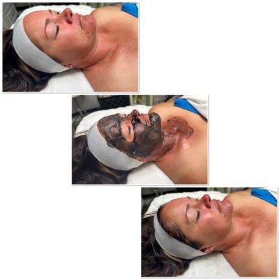 Glo2 Facial Balance Treatment - treat mild acne for glowing results