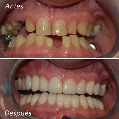 Vista Oasis Smiles - antes y despues de tratamiento dental