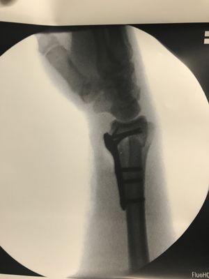 Side view. What's a few screws through your bone amongst friends?