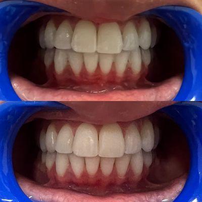 Before & After a 60 mins teeth whitening procedure