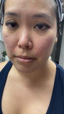 Allergic reaction to products