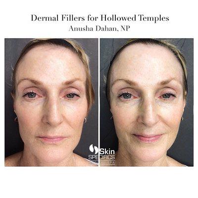 Temple filler for widening and balancing volume loss of the upper face