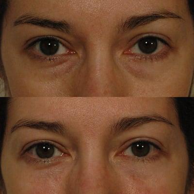 Juvederm injections for dark circles under the eyes.