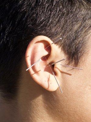 Ear acupuncture for stress relief