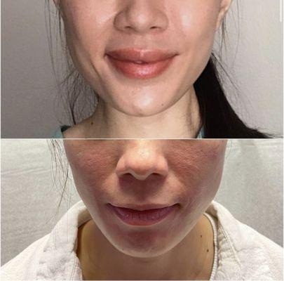 Top: After Bottom: Before; Lip Fillers placed for more volume and strategically placed to look natural. Fillers in chin and smile lines.