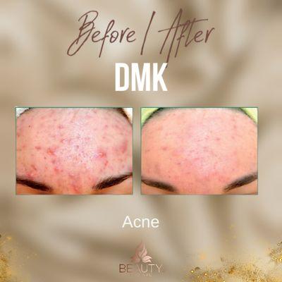 DMK enzymes therapy. Acne, hyperpigmentation, aging skin, dull skin