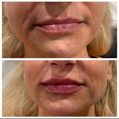 Versa lip filler ! 1 full syringe!