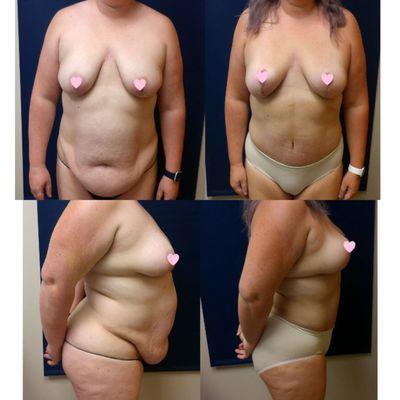 36 year old underwent mommy makeover! She had extended tummy tuck, lipo of her love handles, chin/jowls, and inner thighs, and breast lift!