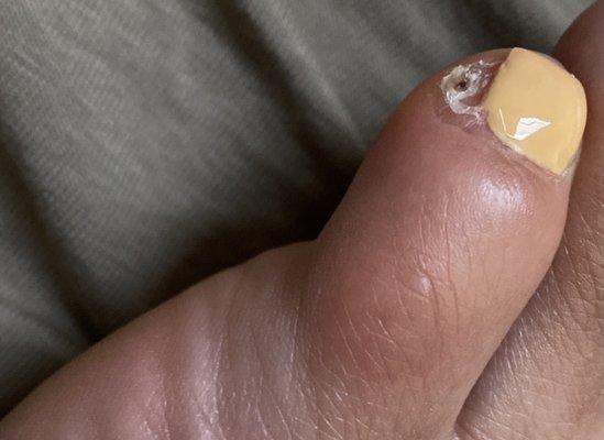 PRETTY SURE IM INFECTED! My whole toe is swollen.