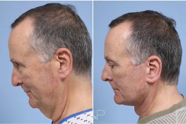 Male L&P Signature Facelift & Neck Lift with tissue contouring and a fat transfer