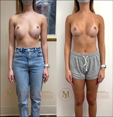 2 Months Postop Breast Augmentation Revision by Dr. Michael J. Yoo, MD - Double Board Certified Plastic Surgeon