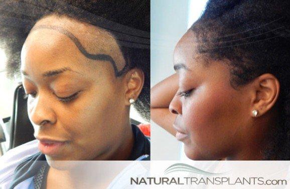 Traction Alopecia Regrowth