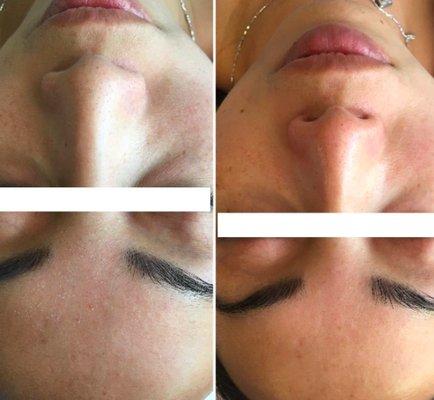 Before and After of Vitamin C Facial