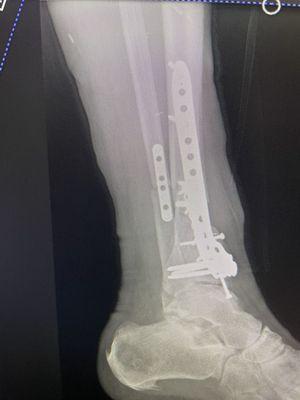 Side view of my new hardware additions to my leg bones.