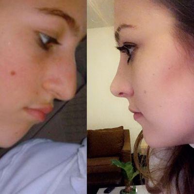 Nose job results