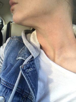 Neck "micro needled".. no numbing. Obvious white line in the center of my neck that was untouched