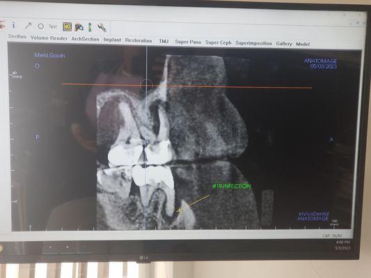 My Infection. Cool 3d x-ray.