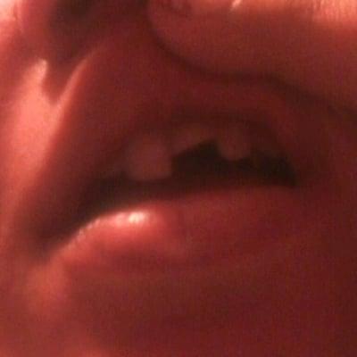 This is my broken front tooth after the slip and fall at the concert. ='(