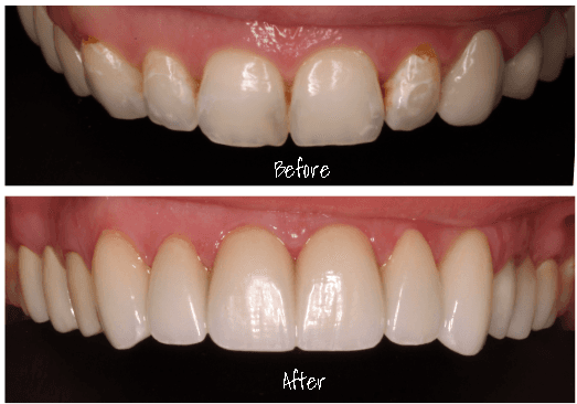 A beautiful transformation with 6 custom porcelain veneers!