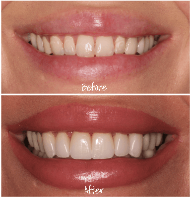 A brand new smile for our patient!