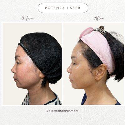 Potenza before & after 2 weeks