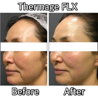 Thermage  Contact us for more information