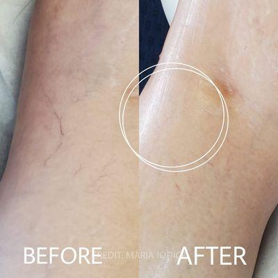 Spider vein removal by Mariya