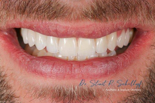 10 veneers to correct this patient's malalignment, cross bite, and appearance