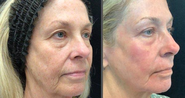 laser resurfacing