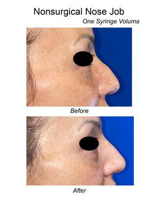 Actual Patient - Nonsurgical "Nose Job" with Filler