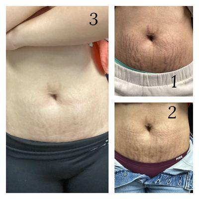 Stretch mark revision 3 sessions so far we can add more if wanted then add a camouflage or leave it as is