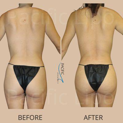 Back lipo