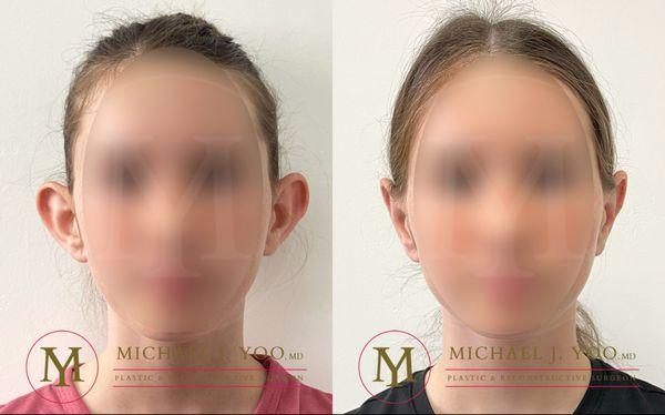 Otoplasty - 'aka' Ear Pinning Surgery - by Dr. Michael J. Yoo, MD - Double Board Certified Plastic Surgeon