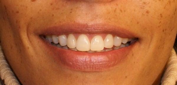 Before BriteSmile Whitening